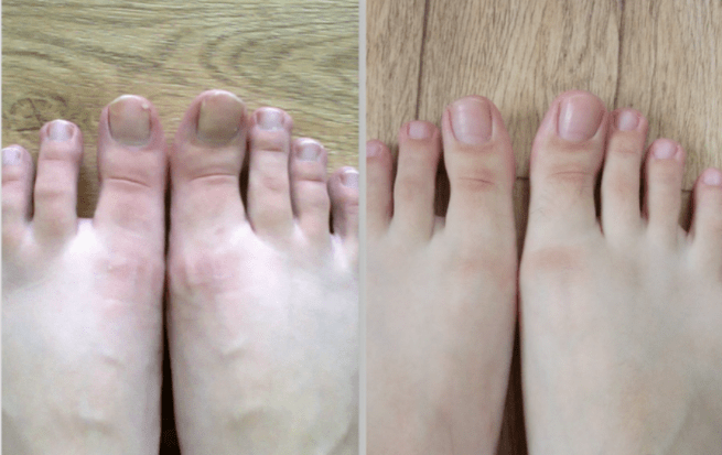 Avant et après le traitement de la mycose des ongles des pieds. 