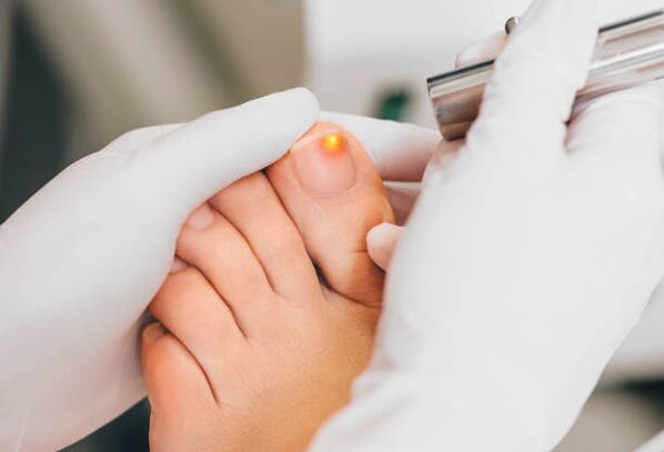 Traitement au laser pour la mycose des ongles des pieds. 