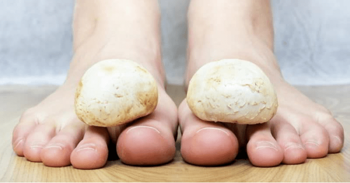 Traitement rapide des champignons dans les jambes à la maison
