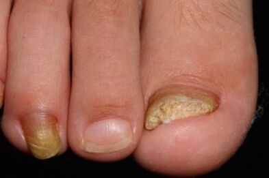 Mycose des ongles de jambe