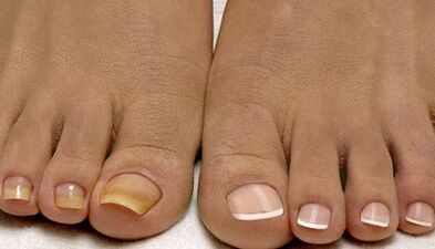 Les causes de l'apparence de champignon sur les ongles