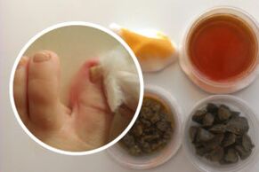 Traitement de la mycose des ongles des pieds avec des remèdes maison.