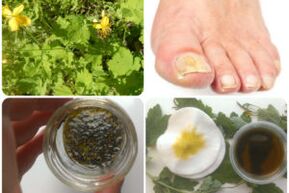 remèdes maison contre la mycose des ongles des pieds